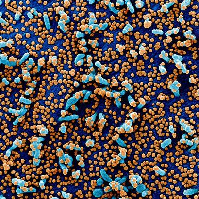 SARS-COV2 virus particles on human cells
